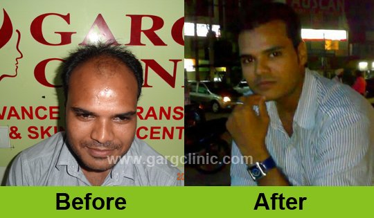 Garg Hair Transplant Clinic