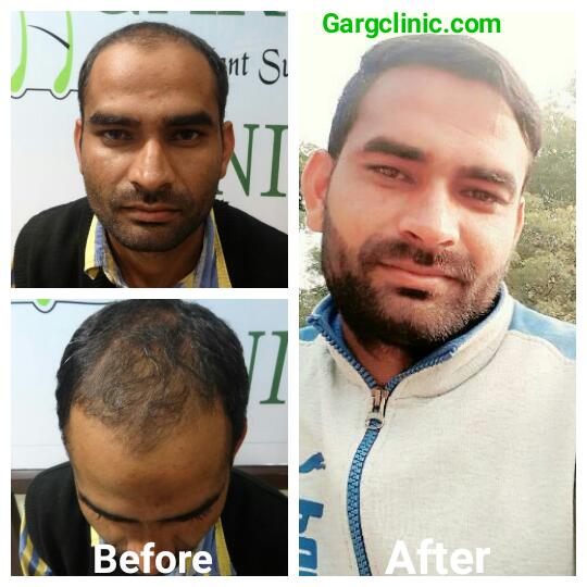 Garg Hair Transplant Clinic