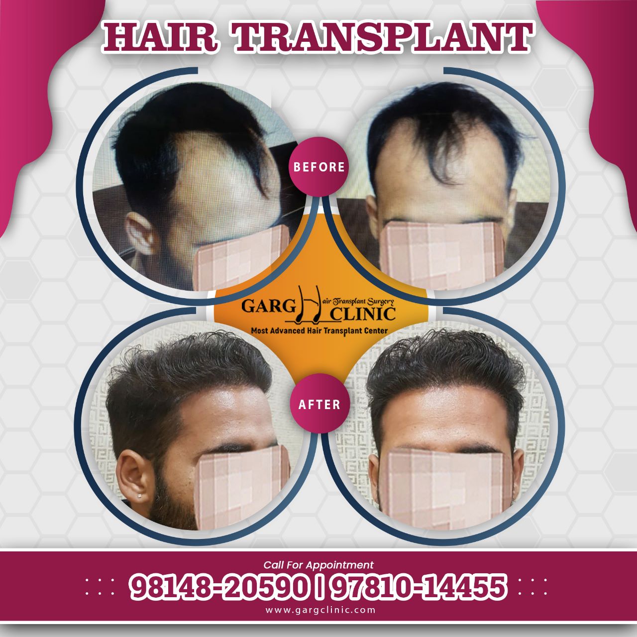 Garg Hair Transplant Clinic