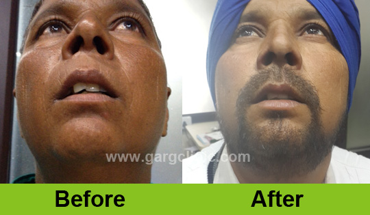 Garg Hair Transplant Clinic