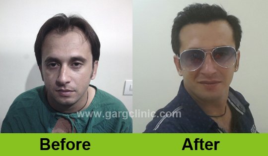 Garg Hair Transplant Clinic