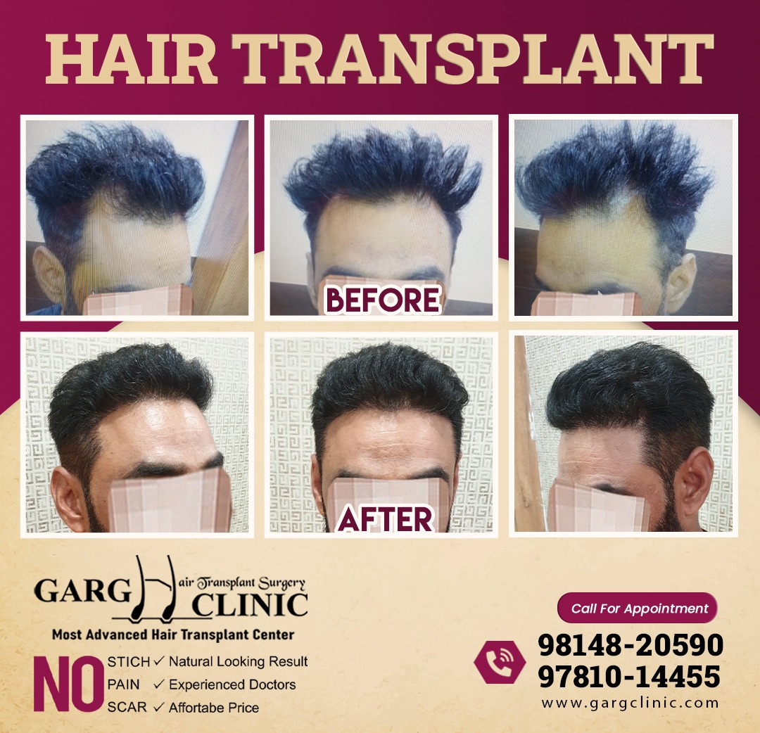 Garg Hair Transplant Clinic