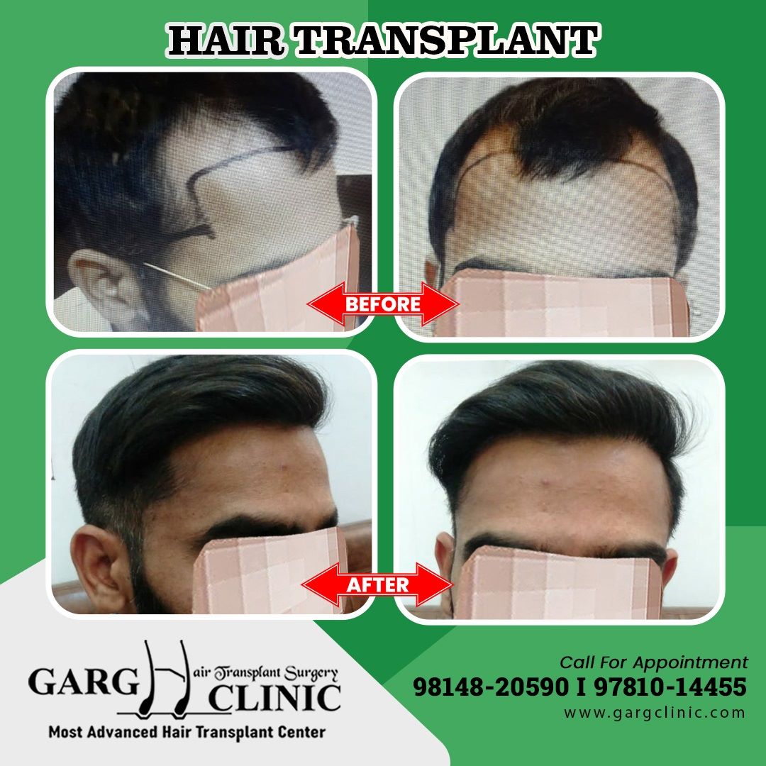 Garg Hair Transplant Clinic