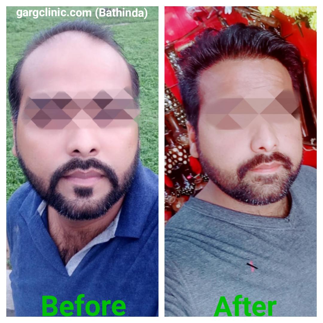 Garg Hair Transplant Clinic