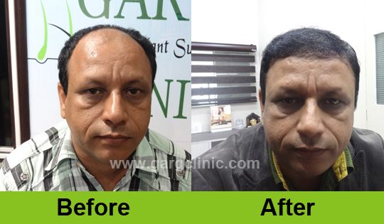 Garg Hair Transplant Clinic