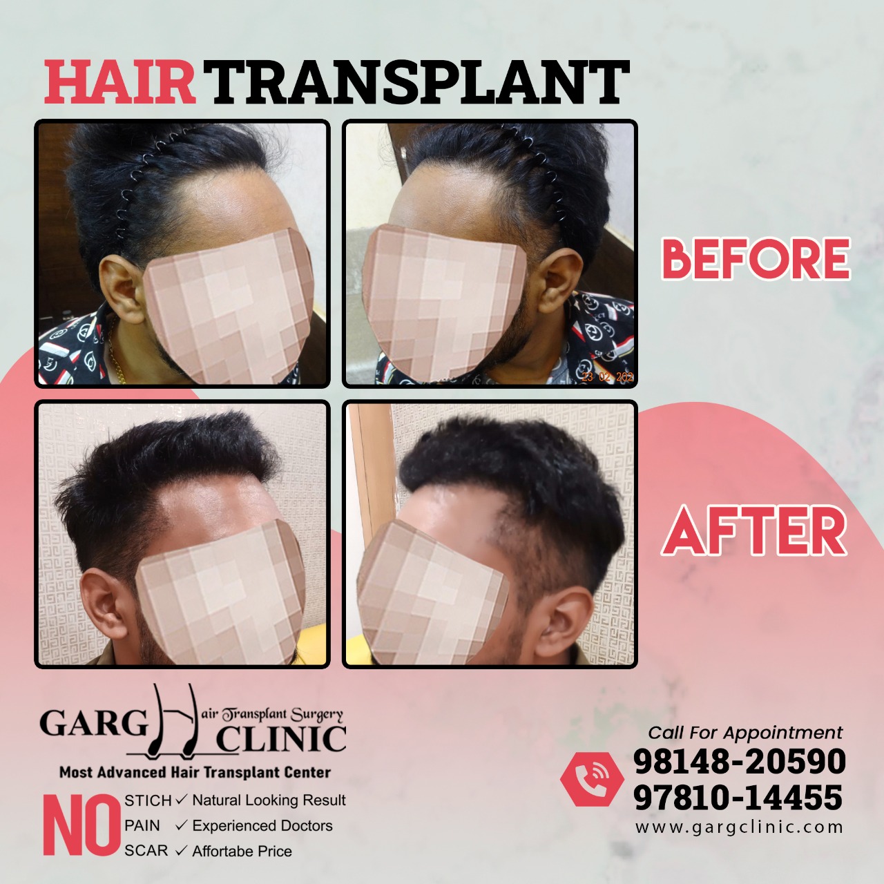 Garg Hair Transplant Clinic
