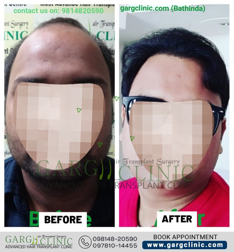 Garg Hair Transplant Clinic