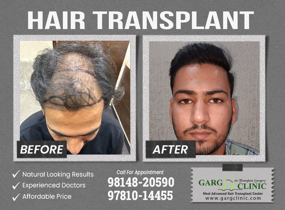 Garg Hair Transplant Clinic