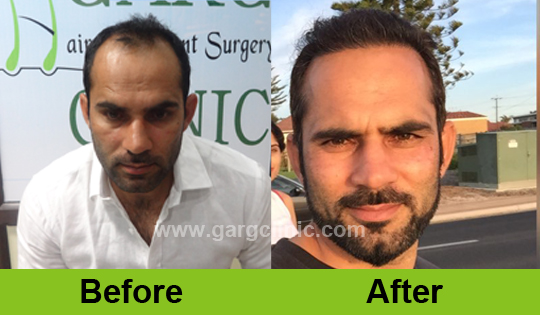 Garg Hair Transplant Clinic