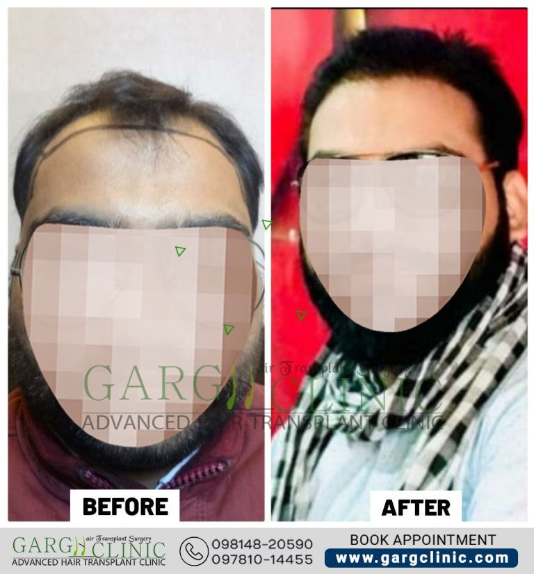 Garg Hair Transplant Clinic