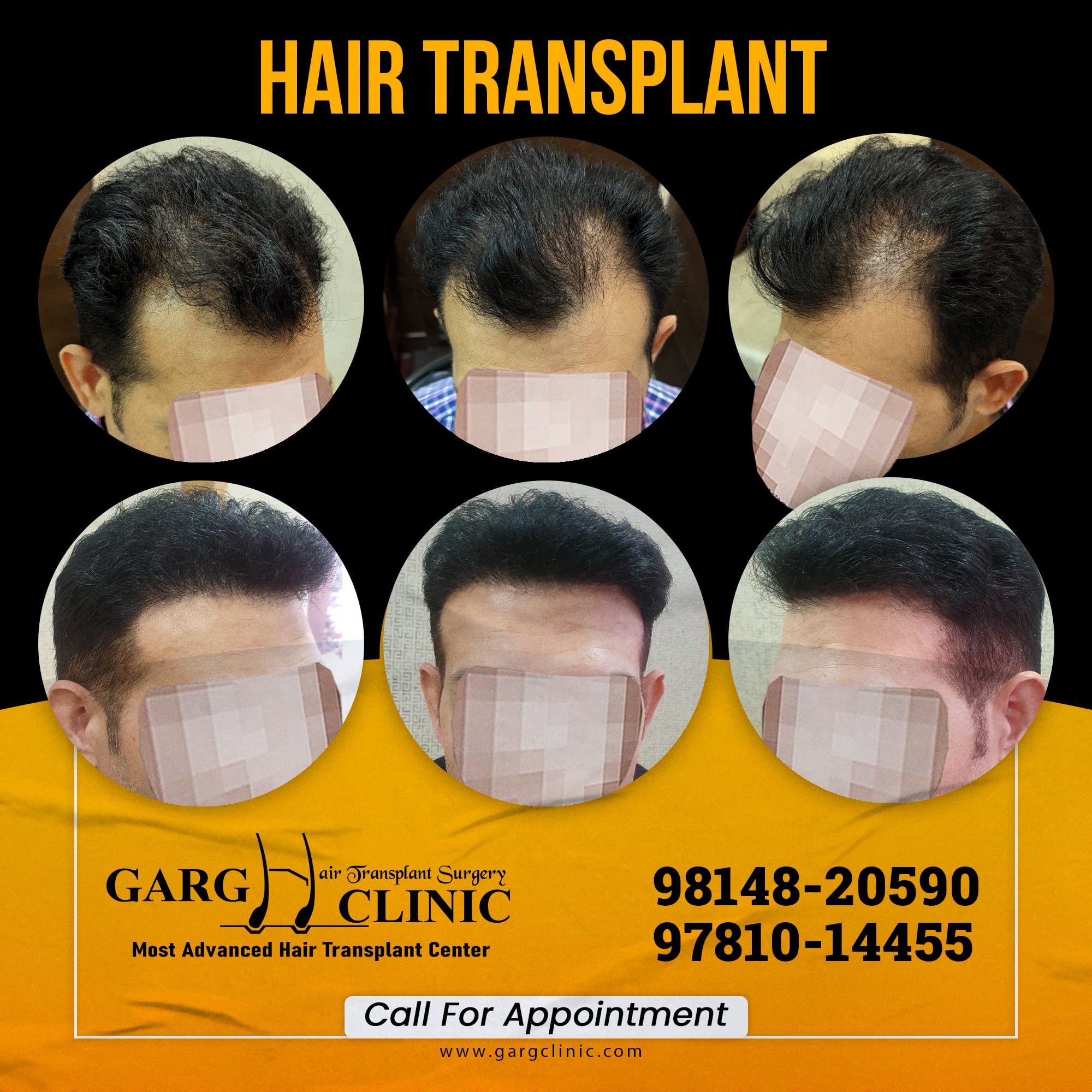 Garg Hair Transplant Clinic