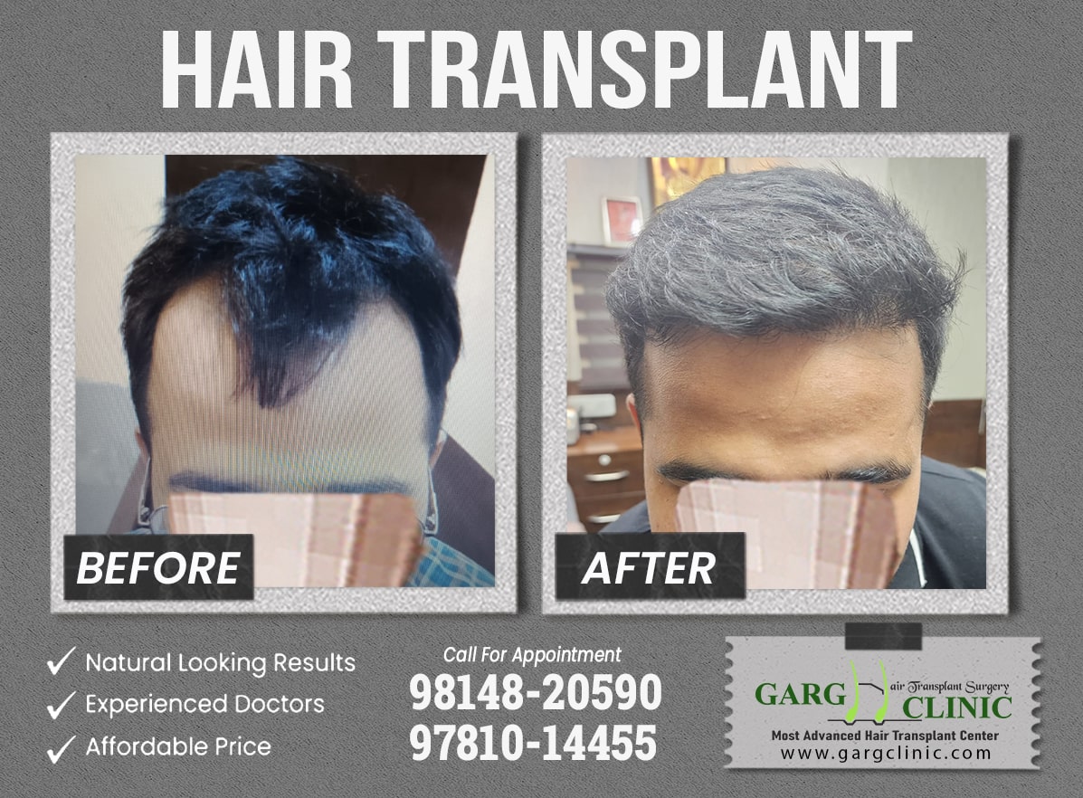 Garg Hair Transplant Clinic
