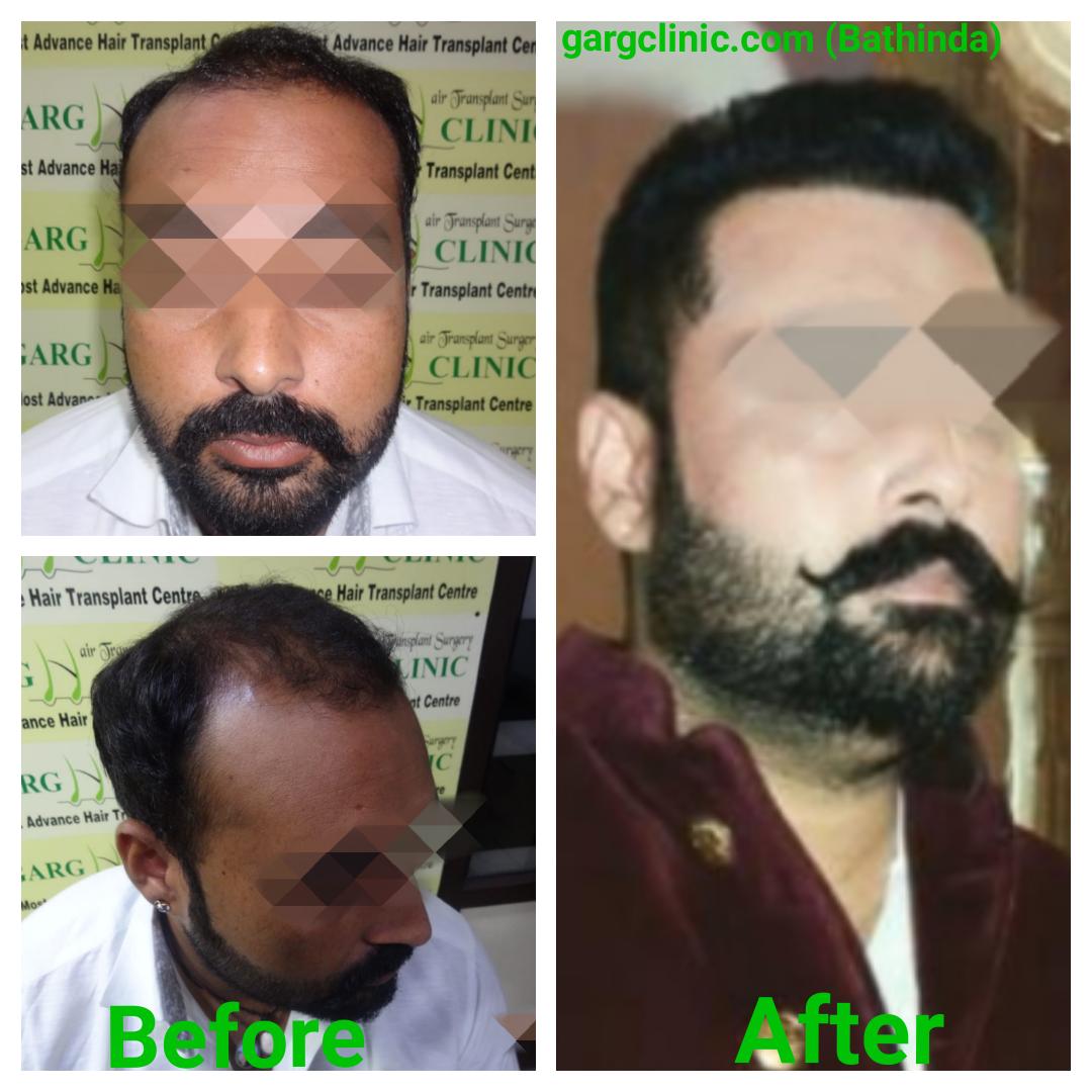 Garg Hair Transplant Clinic