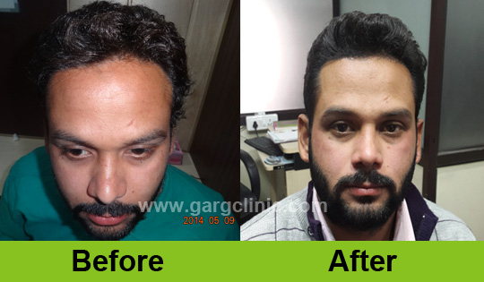 Garg Hair Transplant Clinic