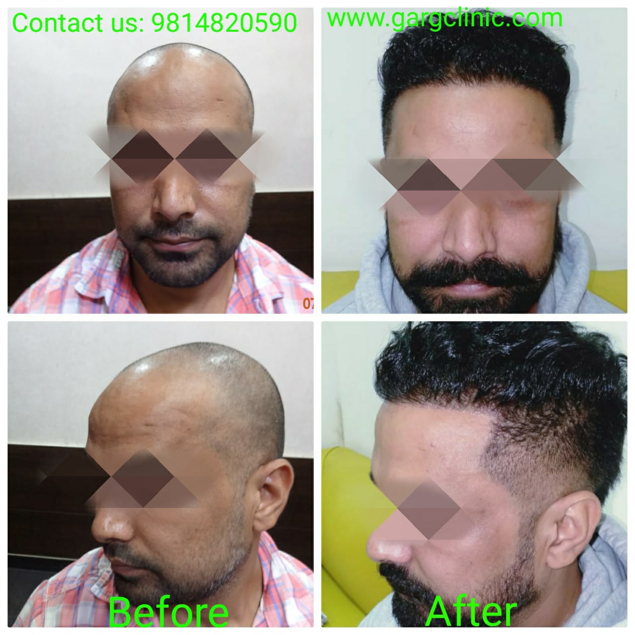 Garg Hair Transplant Clinic