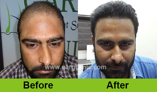 Garg Hair Transplant Clinic