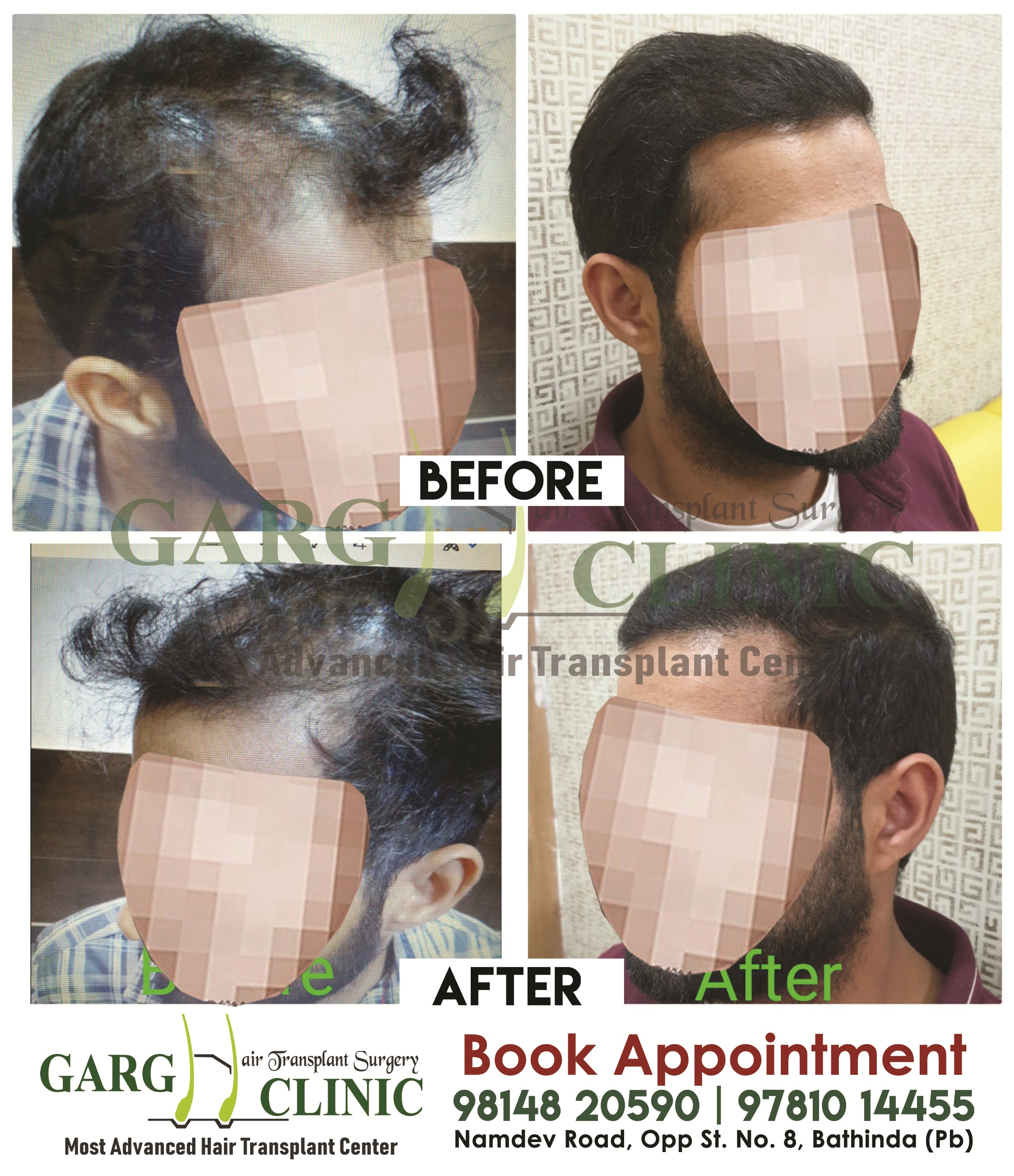 Garg Hair Transplant Clinic