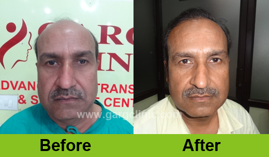 Garg Hair Transplant Clinic