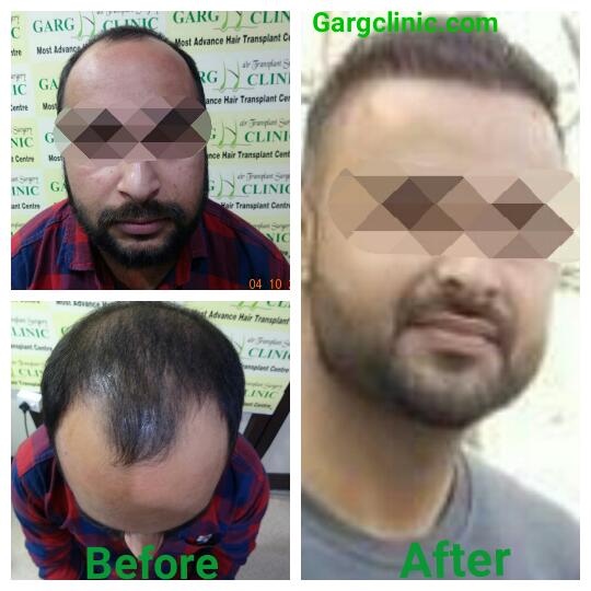 Garg Hair Transplant Clinic