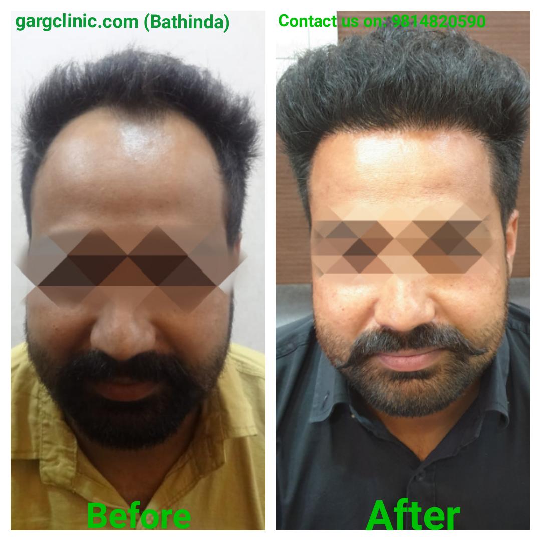 Garg Hair Transplant Clinic