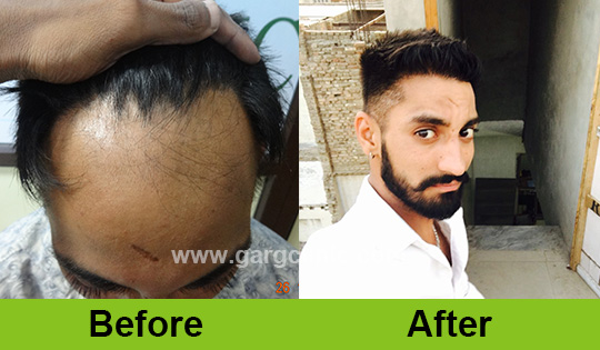 Garg Hair Transplant Clinic