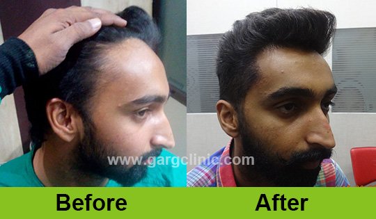 Garg Hair Transplant Clinic