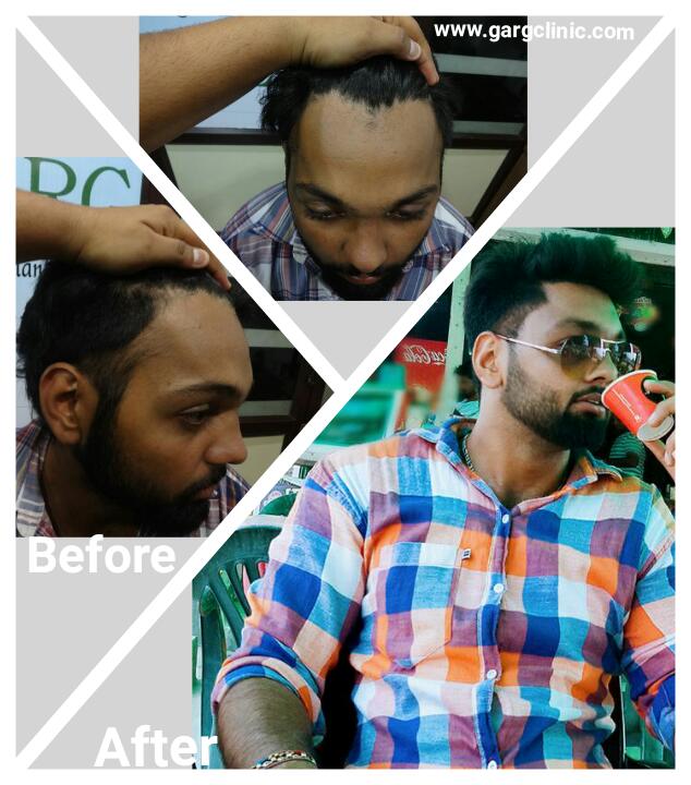 Garg Hair Transplant Clinic