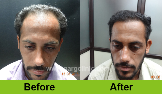 Garg Hair Transplant Clinic