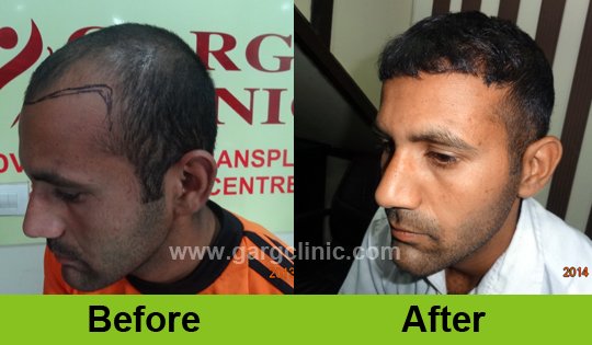 Garg Hair Transplant Clinic