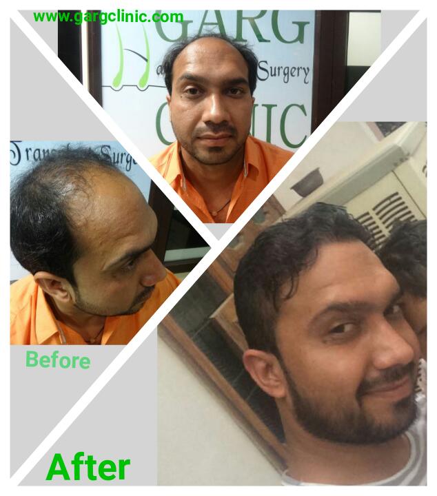 Garg Hair Transplant Clinic