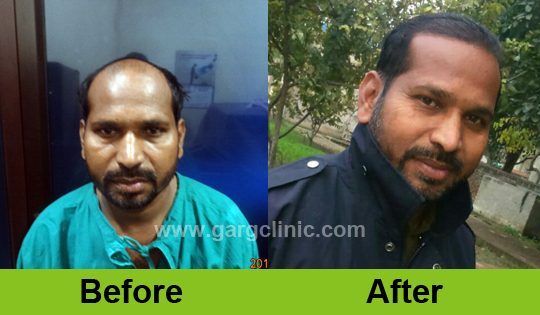 Garg Hair Transplant Clinic