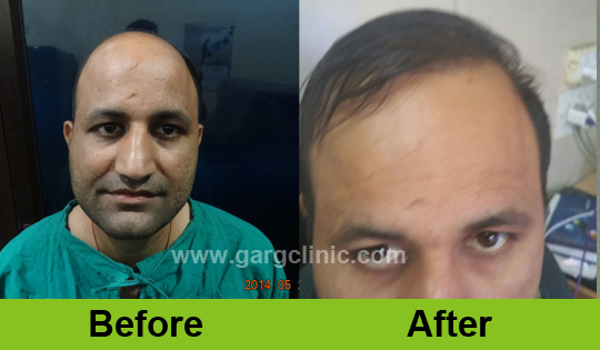 Garg Hair Transplant Clinic
