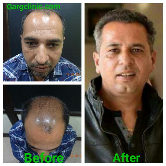 Garg Hair Transplant Clinic