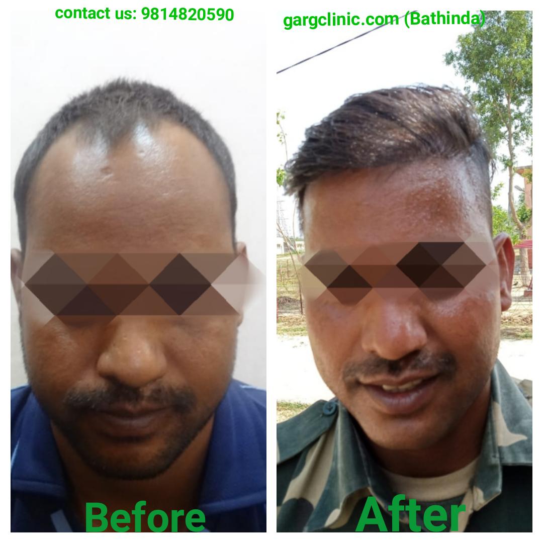 Garg Hair Transplant Clinic