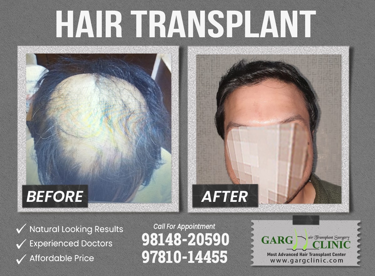 Garg Hair Transplant Clinic
