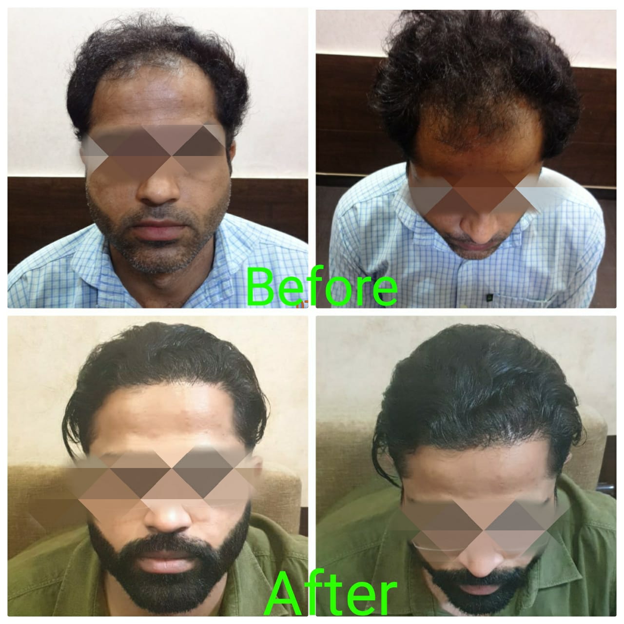 Garg Hair Transplant Clinic
