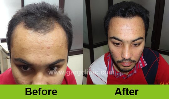 Garg Hair Transplant Clinic