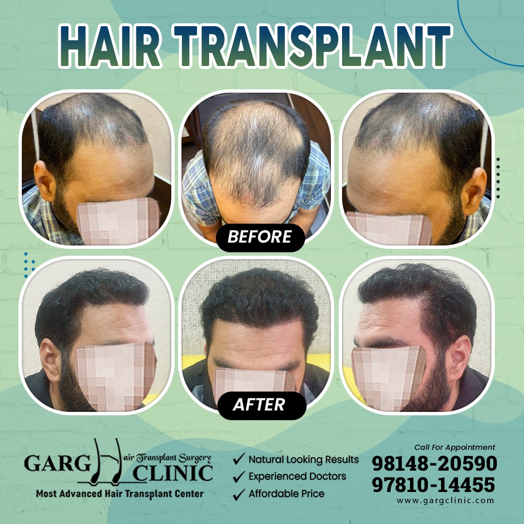 Garg Hair Transplant Clinic
