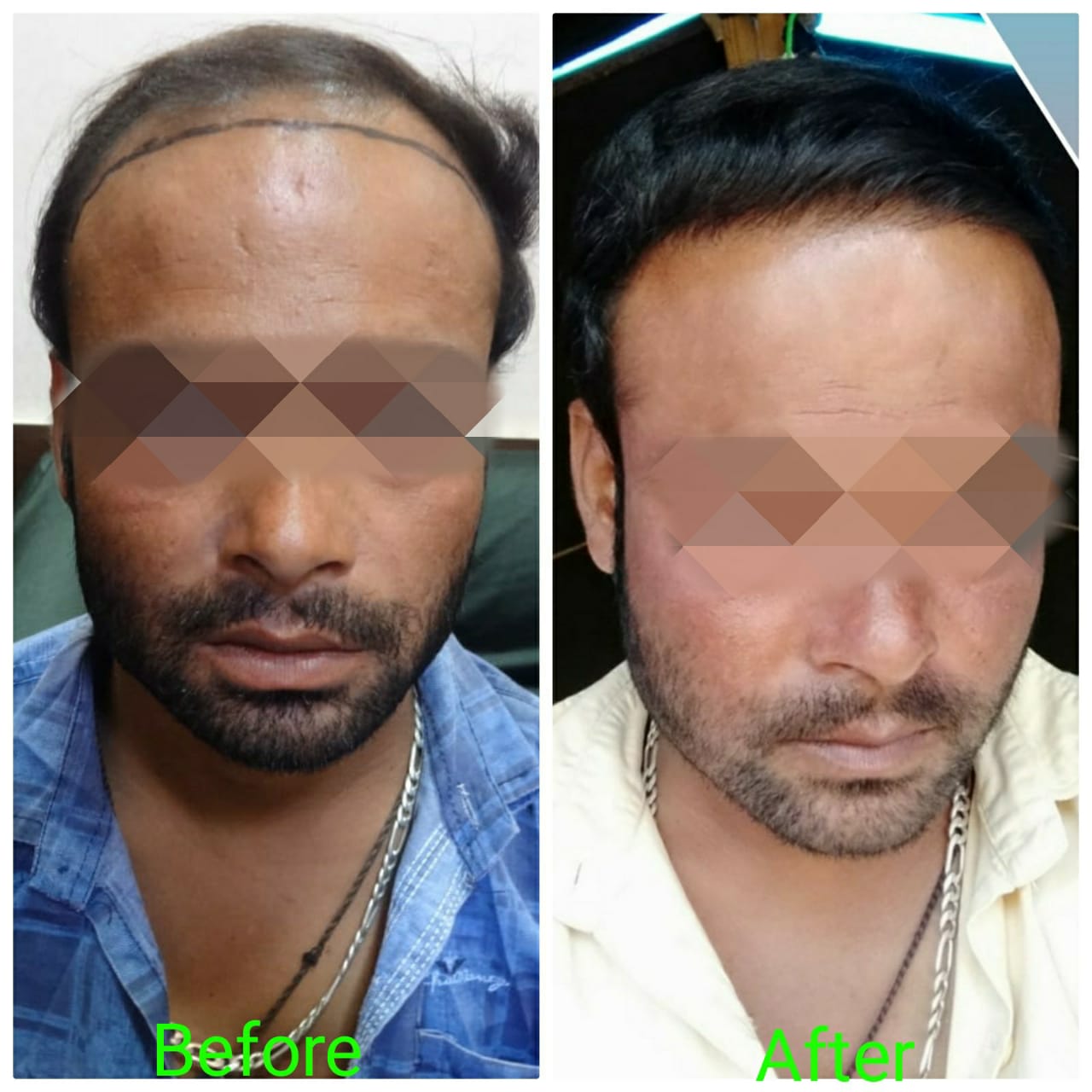 Garg Hair Transplant Clinic