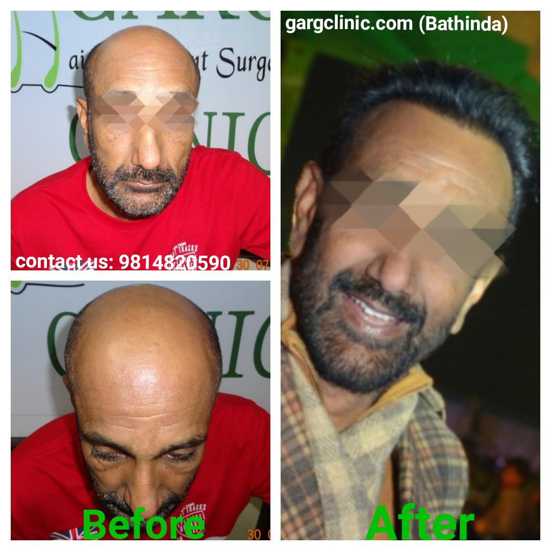 Garg Hair Transplant Clinic