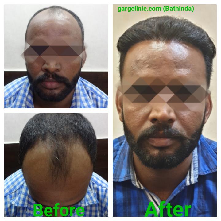 Garg Hair Transplant Clinic
