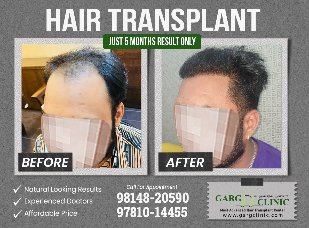 Garg Hair Transplant Clinic