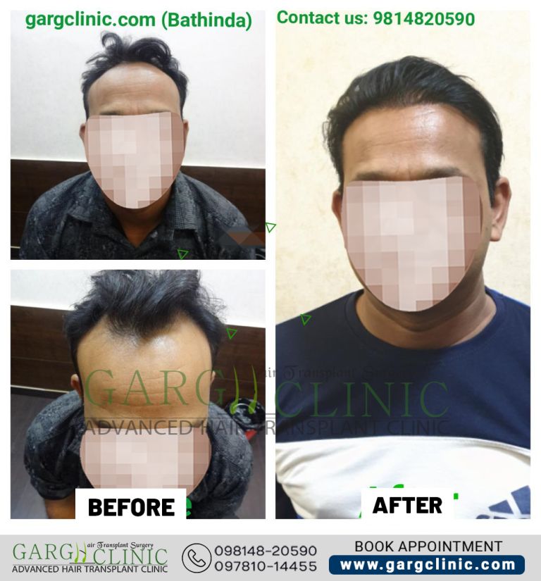 Garg Hair Transplant Clinic