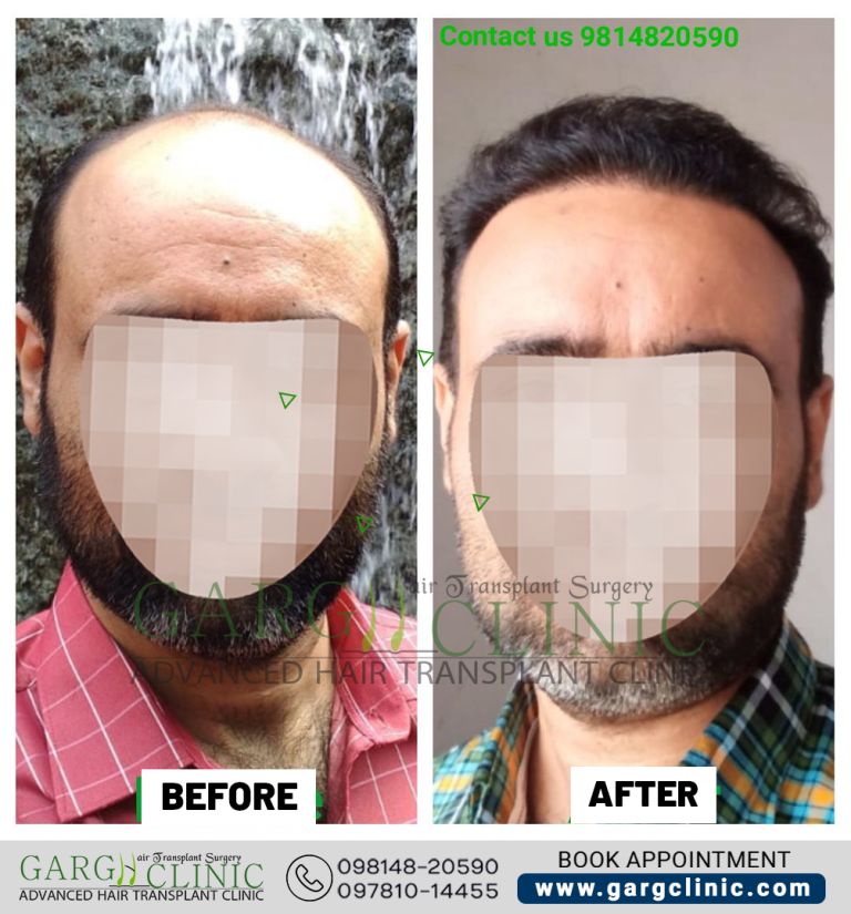 Garg Hair Transplant Clinic