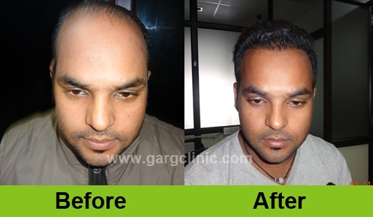 Garg Hair Transplant Clinic