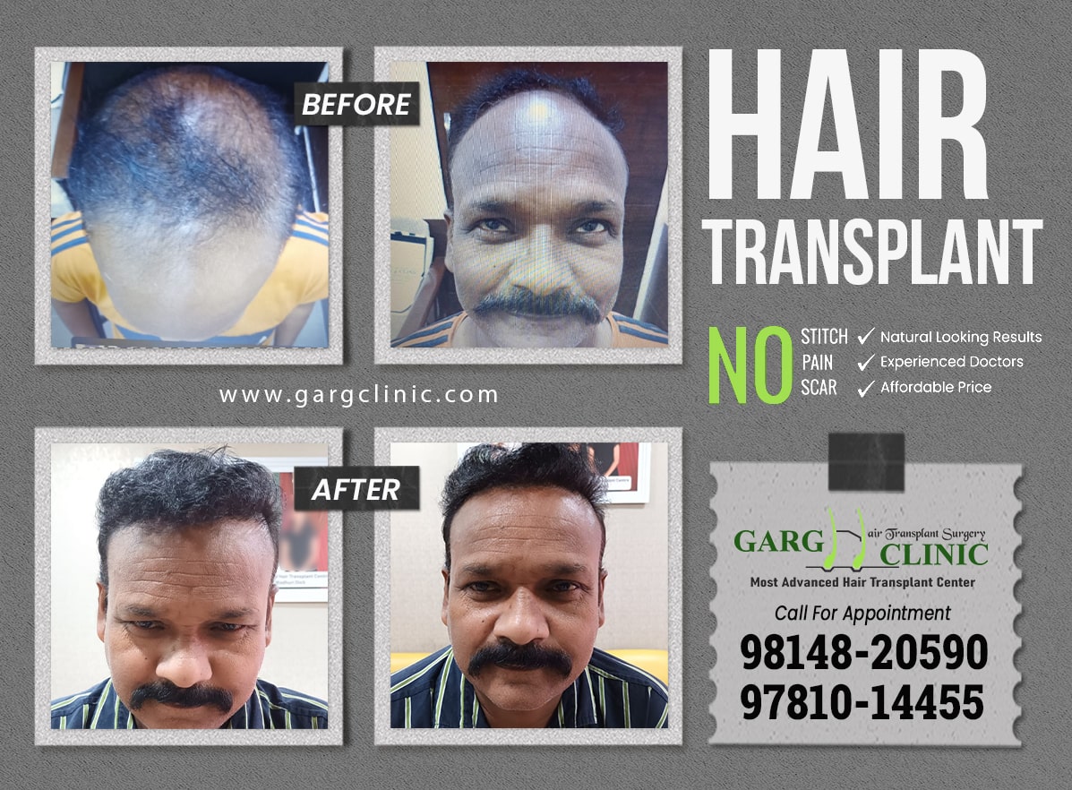 Garg Hair Transplant Clinic