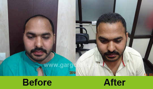 Garg Hair Transplant Clinic
