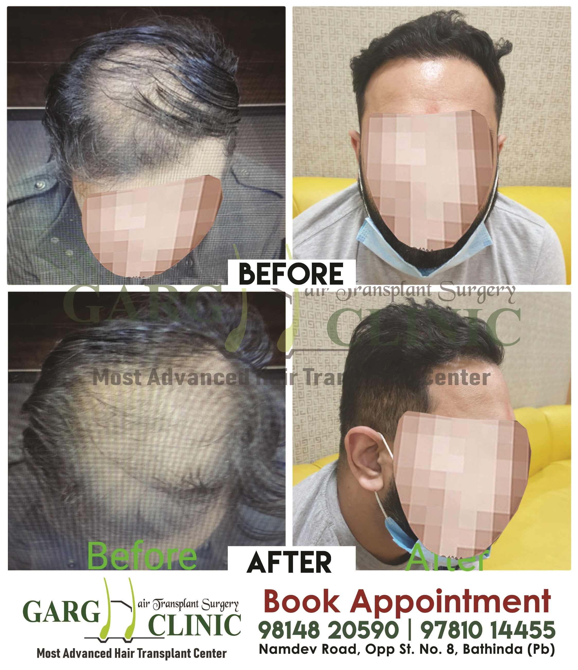 Garg Hair Transplant Clinic