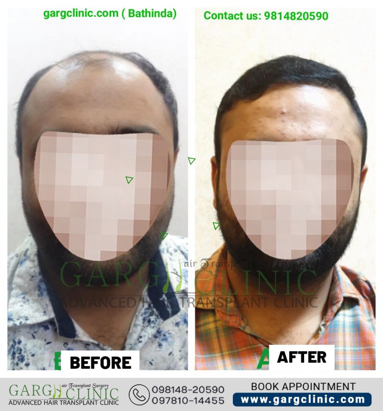 Garg Hair Transplant Clinic