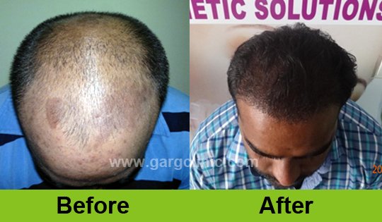 Garg Hair Transplant Clinic